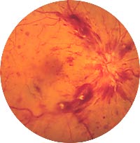 Retinal Vein Occlusion